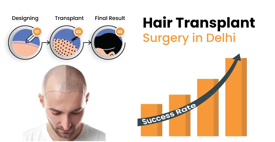 Hair Transplant Surgery in Delhi - DMC Trichology