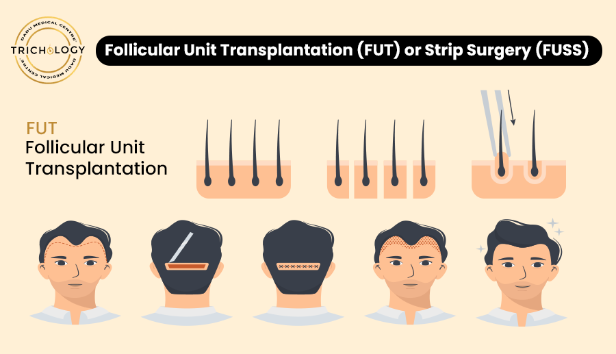 Follicular Unit Transplantation (FUT) or Strip Surgery (FUSS)