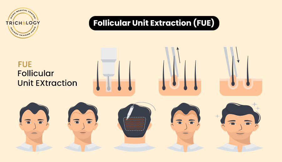 Follicular unit extraction (FUE)