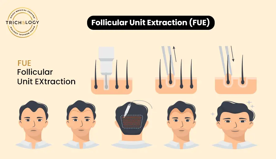 Follicular unit extraction (FUE)