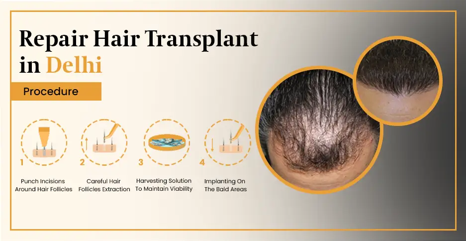 Repair hair transplant in delhi | DMC Trichology