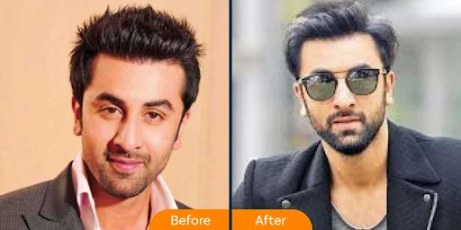 Ranveer Kapoor Hair Transplant