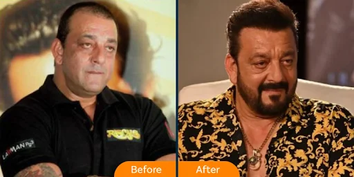 Sanjay Datt Hair Transplant