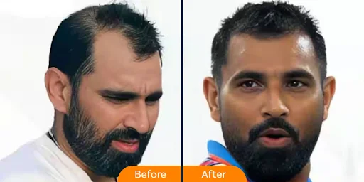 Mohd. Shammi Hair Transplant