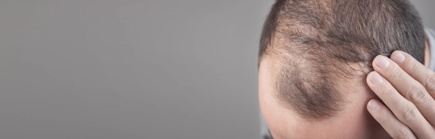 Male Pattern Hair Loss Treatment in Delhi