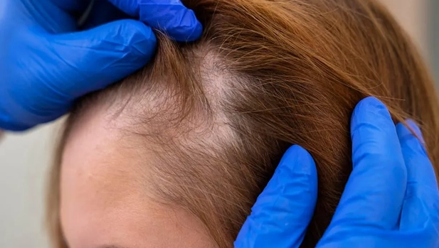 Let's get Women Hair Transplant in Delhi and also know the Women Hair Transplant Cost in Delhi