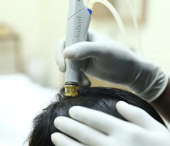 Explore best clinic for keravive scalp treatment in Delhi where you can get keravive hair treatment in Delhi