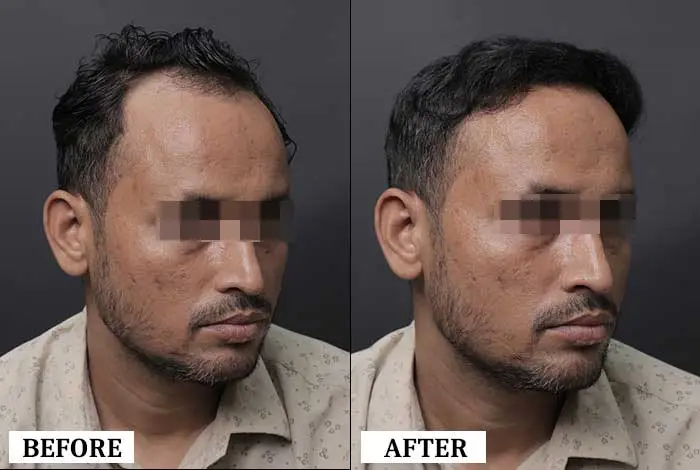 Hair Transplant Before After - Real Result 1