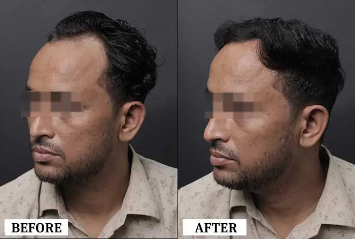 Hair Transplant Before After - Real Result 2