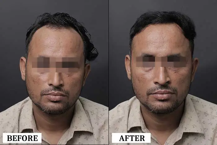 Hair Transplant Before After - Real Result 3