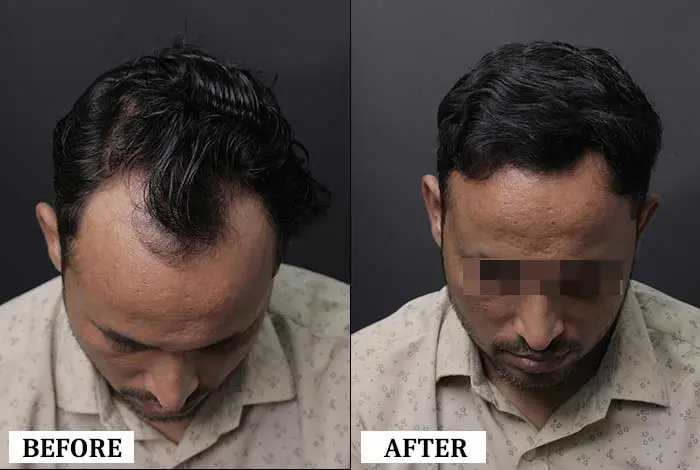 Hair Transplant