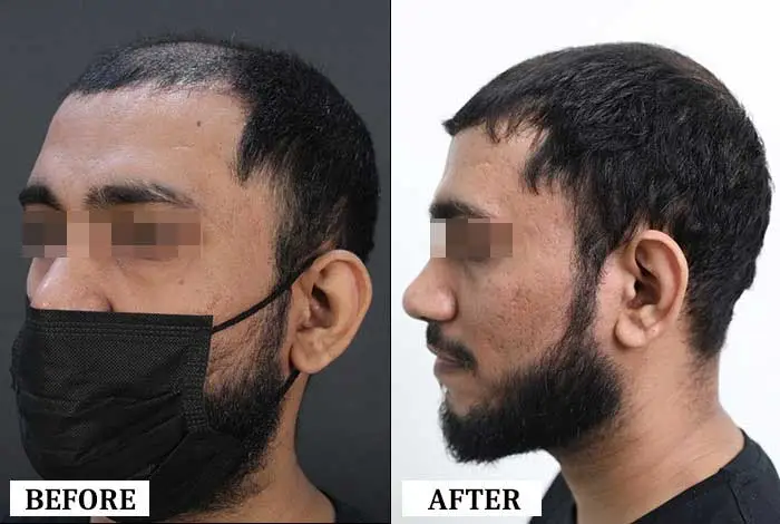 Hair Transplant