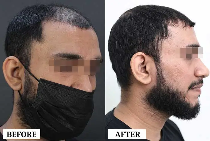 Hair Transplant