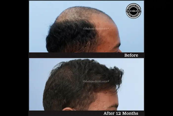 Hair Transplant Before After - Real Result 4