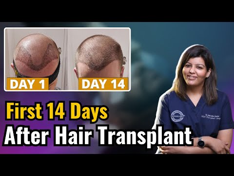 First 14 Days After Hair Transplant | Dos and Don'ts | Dr. Nandini Dadu